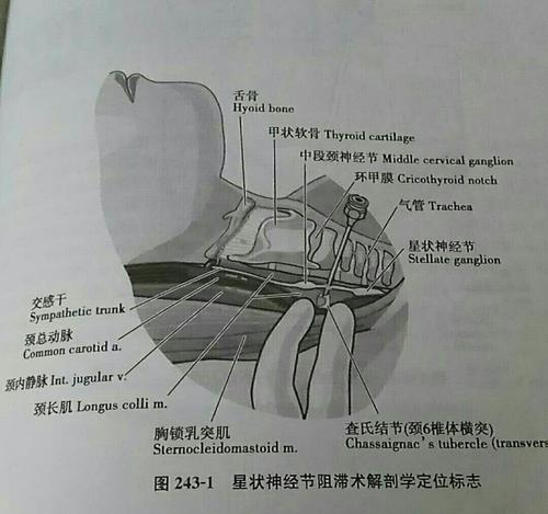 颈源性头痛的星状神经节阻滞疗法及运动推荐