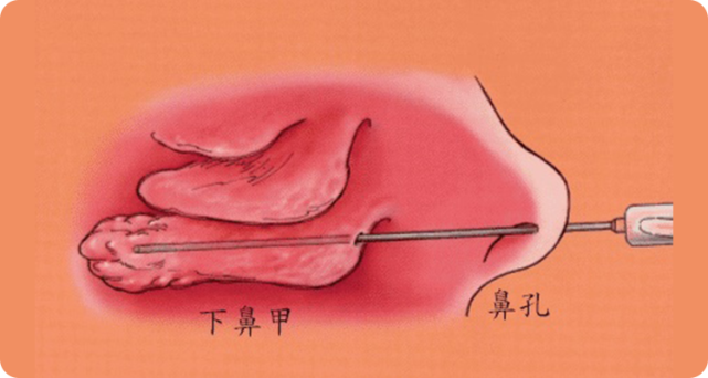 在各种治疗鼻甲肥大的手术方式中,鼻内镜下下鼻甲黏膜下部分切除术