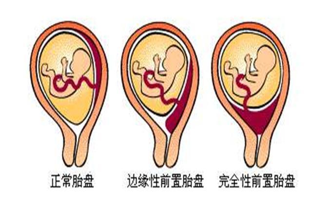 三类孕妈易出现前置胎盘,到了这一周还没纠正,乖乖接受剖腹产吧