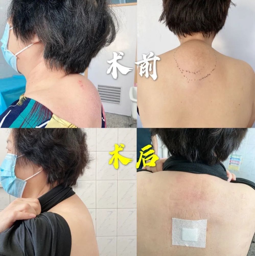 颈部"富贵包"是颈部脂肪瘤的俗称,是一种颈后部生