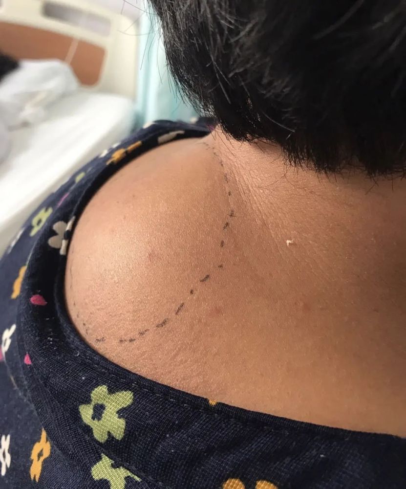 颈部"富贵包"是颈部脂肪瘤的俗称,是一种颈后部生长缓慢,触之柔软的