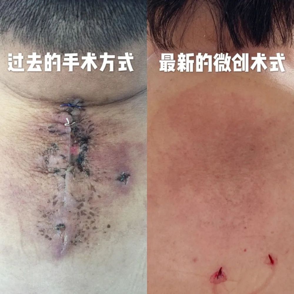 东直门医院骨科外科联合研发微创可视化旋切技术治疗颈部富贵包