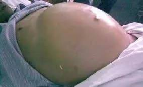 肝腹水会不会传染或遗传 读完此文你就明白了 腾讯新闻