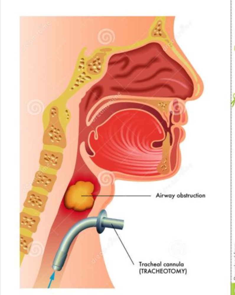 氣管切開的相關適應症_騰訊新聞