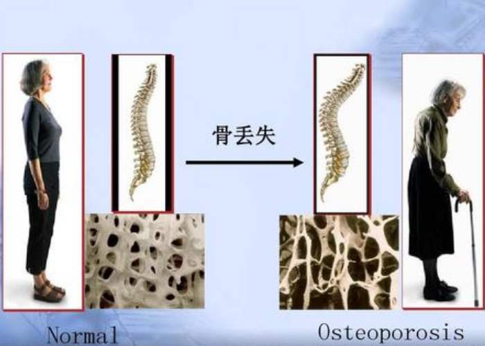 骨质疏松|女人过了50岁，瘦点好还是胖点好？别被“千金难买老来瘦”误导