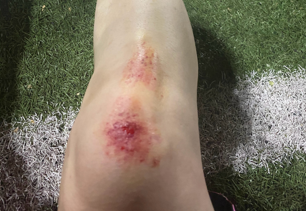 真是惨!德云社张鹤伦踢球受伤求安慰,评论区却被秦霄贤粉丝淹没