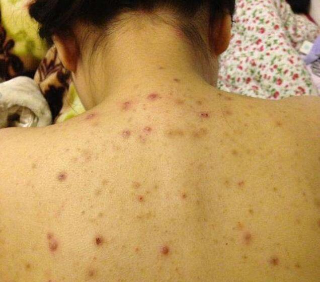 时间久了就会堆积在毛孔里,造成毛孔堵塞甚至发炎形成毛囊炎,所以就