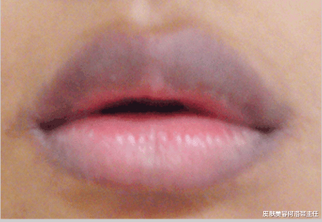 唇色深是什么原因少做这几件事否则唇色越来越深