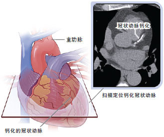 冠状动脉解剖图钙化图片