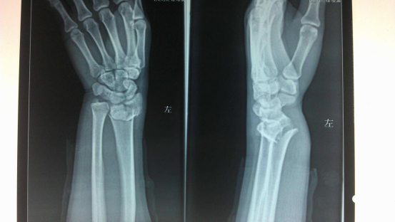 右手尺桡骨远端图片图片
