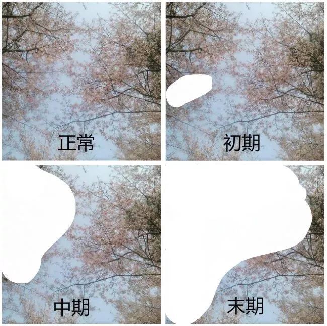 总是感觉眼睛胀痛?一个简单的动作,自测你离青光眼有多远