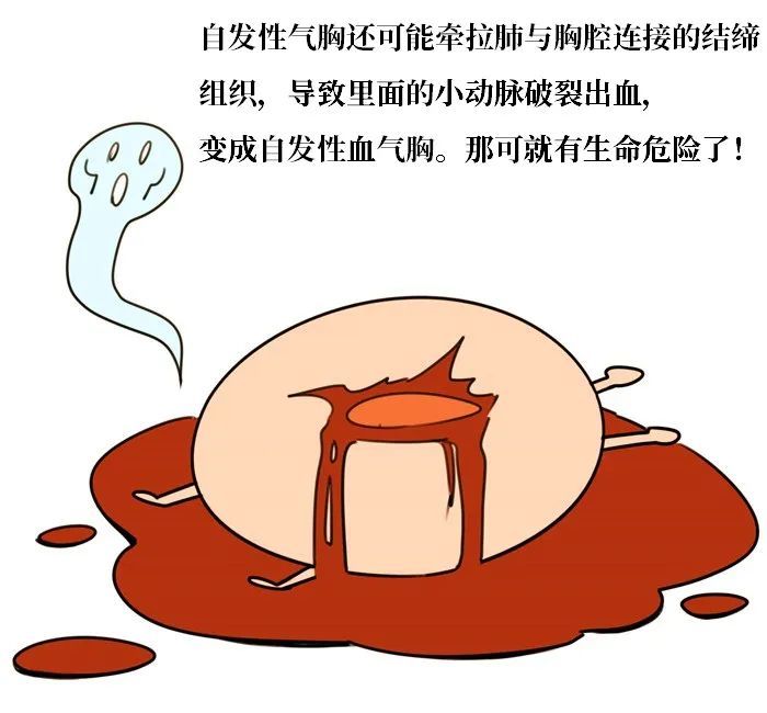 鲁威渔医号丨易燃易爆肺大疱