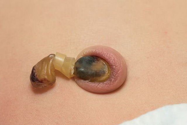 婴儿要饿,大黄退黄疸,脐带治肚子疼?无科学根据别信