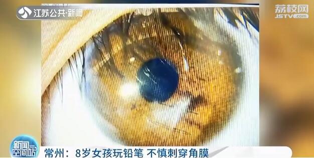 8岁女孩眼睛被铅笔戳到"有点疼"却不料角膜已刺穿