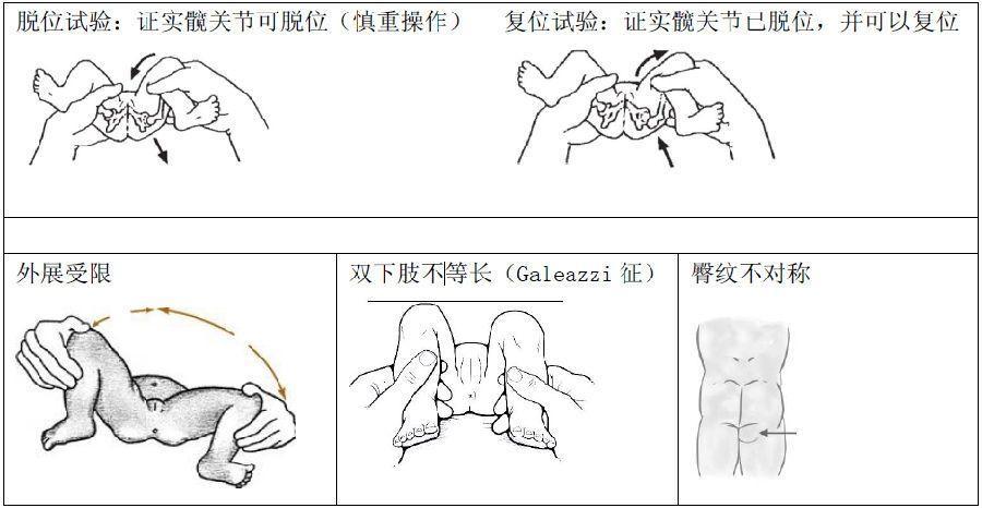 髋关节发育不良有什么症状_髋关节发育不良的症状是什么