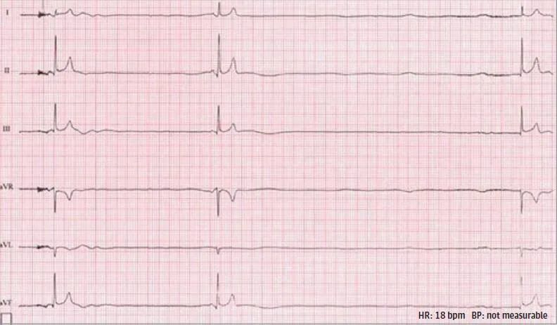 30次/分,晕厥先兆期过渡到交界性心动过缓,晕厥期间窦性停搏超过6秒