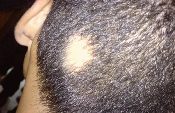 脱发|国宝也脱发？是不是担心起了你的发际线？