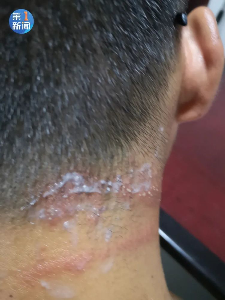 胆小慎入男子拍死脖子上的虫子没想到可怕的一幕出现了