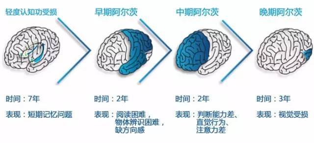 这个黄金窗口期,或可帮助阿尔茨海默症控制延缓病情