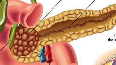 【中醫腫瘤】胰腺腫瘤如何採取中醫治療