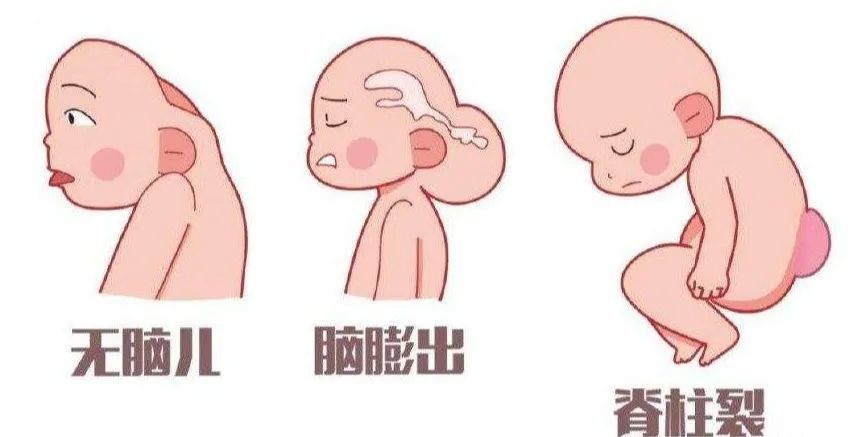 神经管缺陷包括无脑儿,枕骨裂,露脑与脊椎裂.