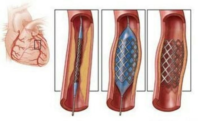 心肌梗塞手术支架图片图片