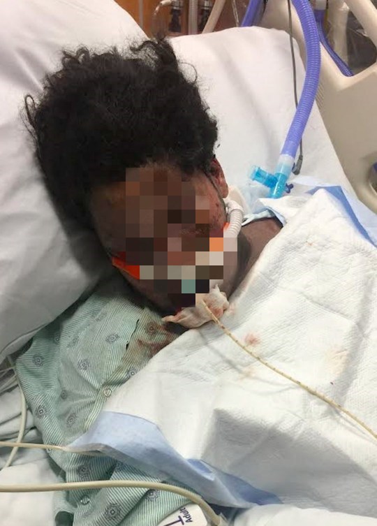 可怕美国少女服用抗焦虑药过敏身体由内而外燃烧惨遭毁容