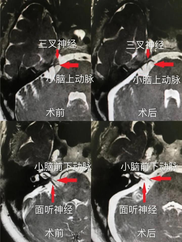 逐步深入,在狭小的空间里找到了三叉神经和面听神经,小心翼翼地梳理