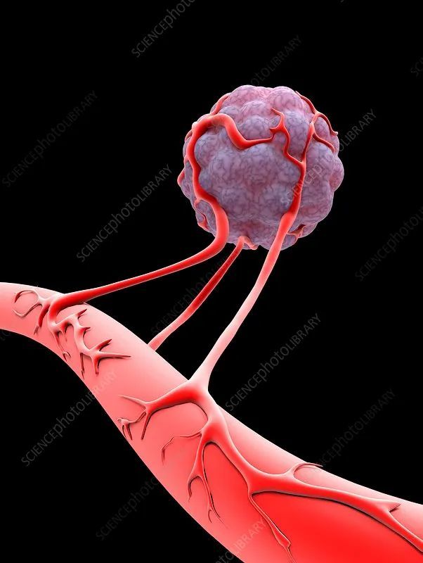 人人体内都可能有微肿瘤健康的血管生成防御系统阻止它们生长