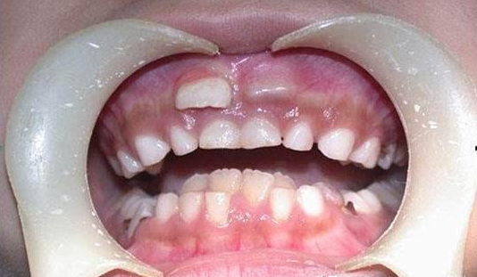 换牙期的孩子注意了如果出现这两种情况请及时拔除乳牙