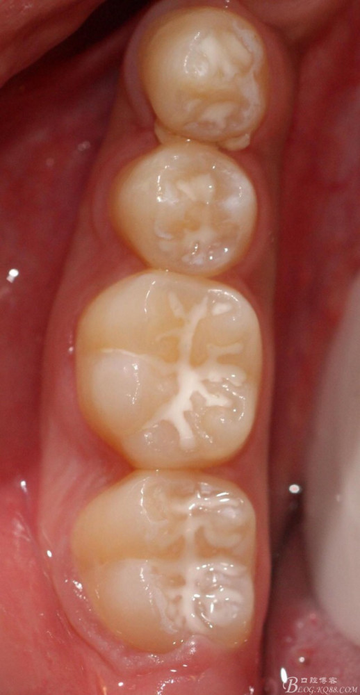有宝宝的妈妈们,你们知道窝沟封闭吗?