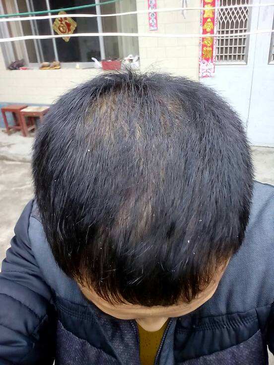 头顶的头发少怎么办三招教你解决生发问题