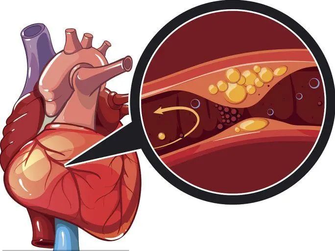 α-亚麻酸|26岁女子，突发心梗离世，生前不碰烟酒，却把一样东西当水喝