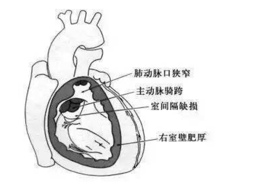 发绀四联症,先天性紫绀四联症四种畸形引起的右室漏斗部或圆锥发育