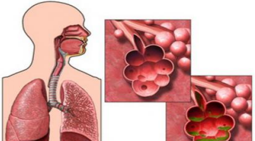 什么是慢性阻塞性肺疾病?