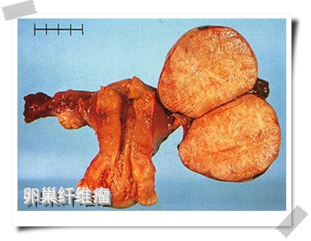卵巢肿瘤的临床表现