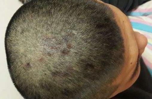 头部脂溢性湿疹