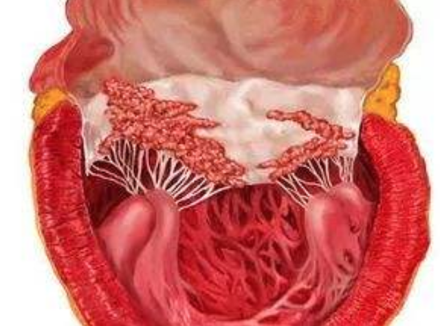 感染性心內膜炎是什麼病