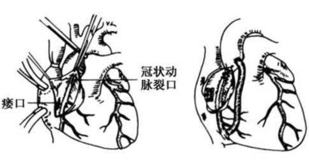 先天性冠状动脉瘘治得好么