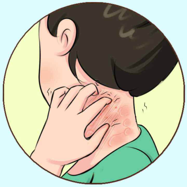 脖子上长湿疹怎么办 找到过敏原是关键 过敏原 过敏体质 颈部 湿疹
