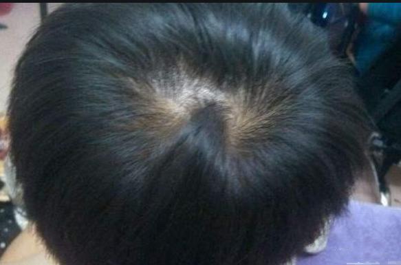 "一个旋愣,两个旋横,三个旋不要惹",娃头上的"旋"你懂哪些