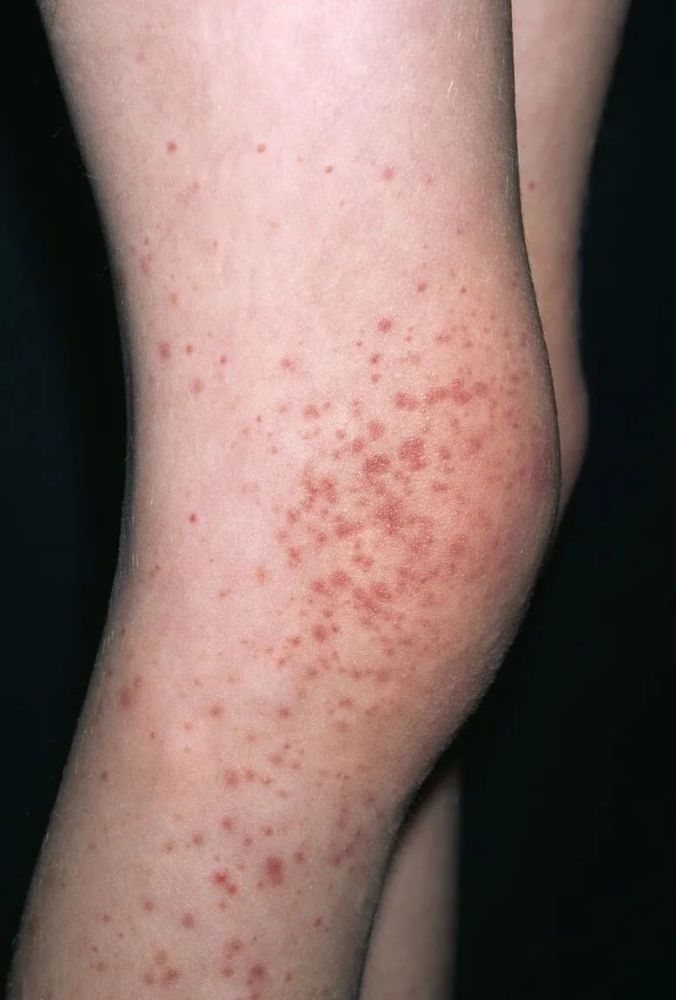 皮肤黏膜出血症状 , 血小板减少 , 血小板寿命缩短 , 巨核细胞总数