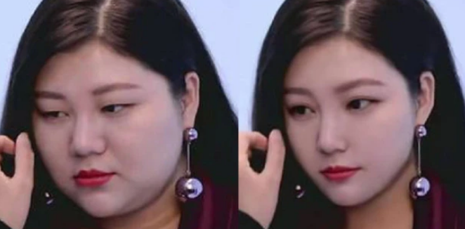 杨天真|杨天真切胃手术一个月后复诊，大肚变瘪瘦好多，网友：感觉变样了