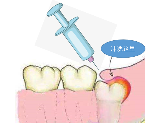 一般對於孕婦的智齒冠周炎,多采取局部雙氧水 生理鹽水交替沖洗,囑