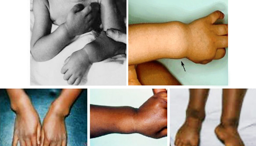 营养维生素d缺乏性佝偻病的概述