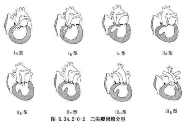 三尖瓣闭锁该如何治疗