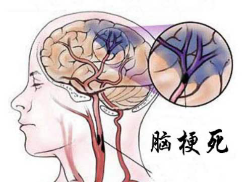 脑梗|脑梗怎么办？