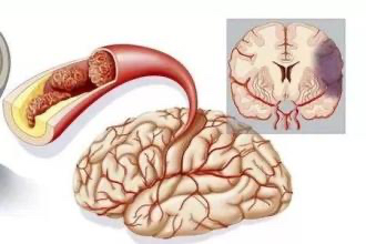 脑梗|脑梗怎么办？