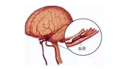 脑血栓|脑血栓怎么办？