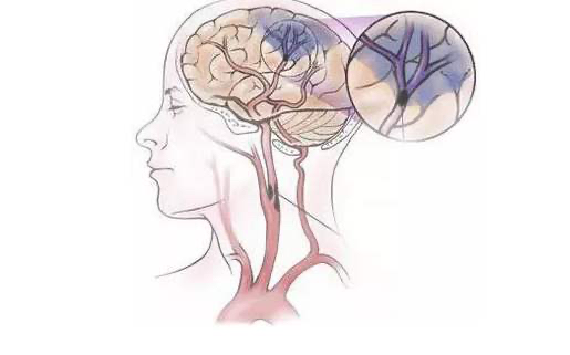 脑血栓|脑血栓怎么办？